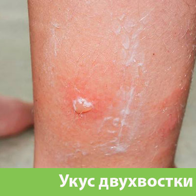 Укус двухвостки в Жуковском