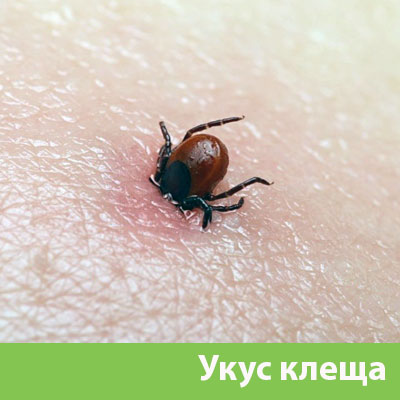 Укус клеща в Жуковском